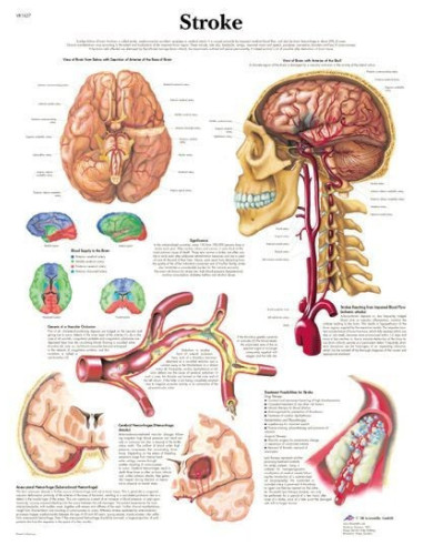 Moždani udar (1627)