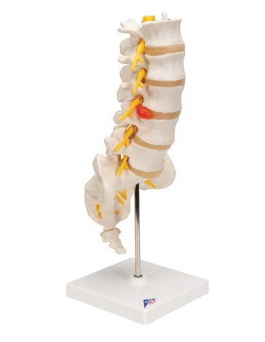 Lumbalna kralježnica+prolapsa