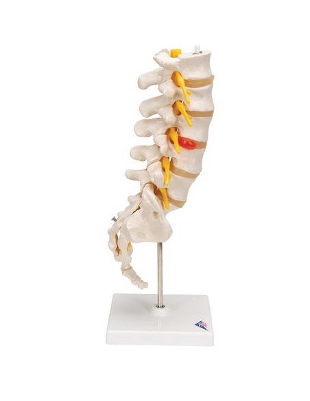 Lumbalna kralježnica+prolapsa