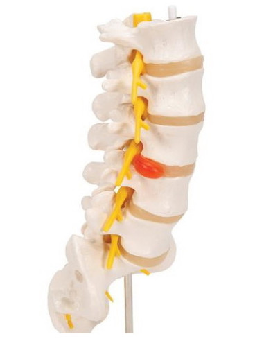 Lumbalna kralježnica+prolapsa