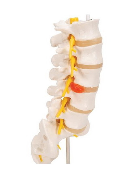 Lumbalna kralježnica+prolapsa