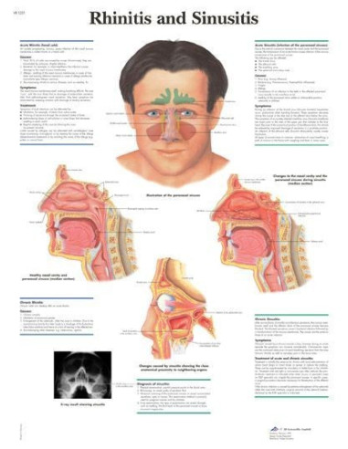 Rinitis i sinusitis (1251)