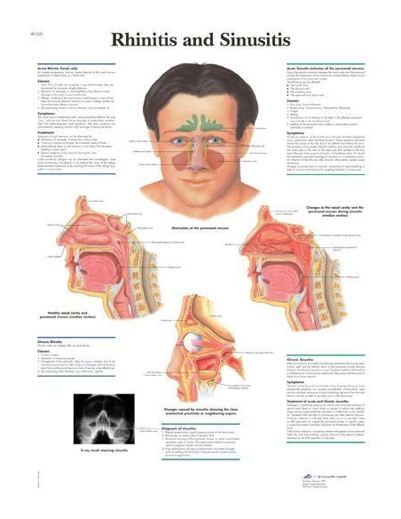 Rinitis i sinusitis (1251)
