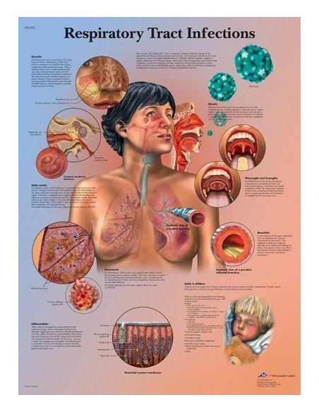 Infekcije dišnih putova (1253)