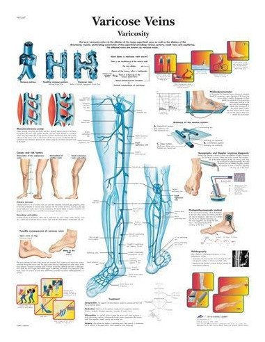 Proširene vene (1367)