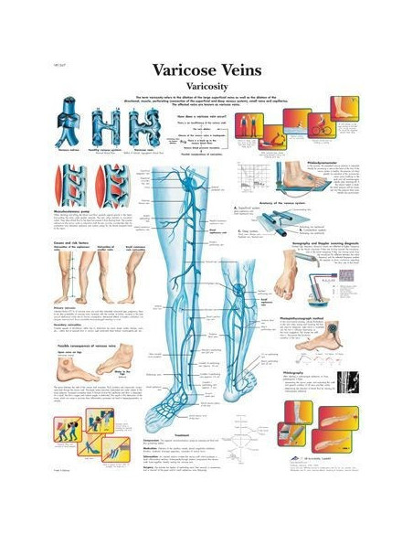 Proširene vene (1367)